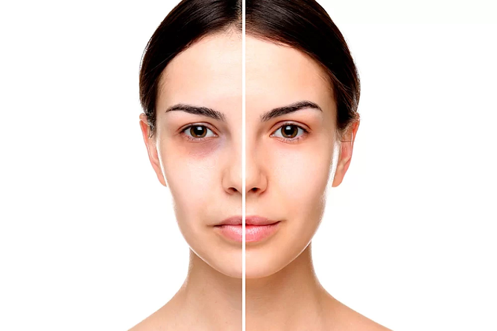 las ojeras y como mejorarlas